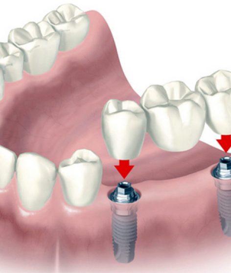 εμφυτεύματα-δοντιών